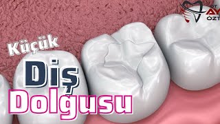 Beyaz Diş Dolgusu Nasıl Yapılır  Kompozit Diş Dolgusu [upl. by Petras]