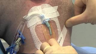 3M™ Tegaderm™ CHG IV Dressing 1657R Application and Removal Video CVC [upl. by Yeleen]