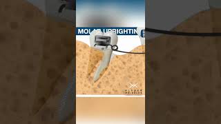 MOLAR UPRIGHTING  ORTHODONTIC TIPS Shorts [upl. by Emse]