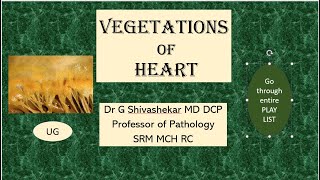 VEGETATIONS OF HEART  Pathology  RATS  MBBS SRM  Dr GSS  University Exam Chart [upl. by Dugas]