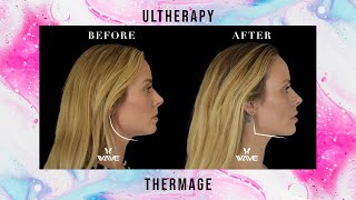 Ultherapy vs Thermage Non Surgical Facelift with Collagen Stimulation  Wave Plastic Surgery [upl. by Marlin]