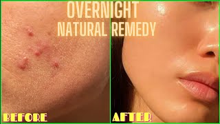 HOW TO GET RID OF ACNE PIMPLES BUMPS ON FACE OVERNIGHT  Simple Home Remedy DIY Lemon Treatment [upl. by Sillyrama570]