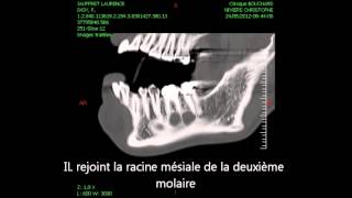 Concept actuel de la préservation de lalvéole lors de lextraction dentaire [upl. by Airak]