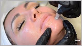 Meso Skin Rejuvenation Video skin needling [upl. by Porush256]