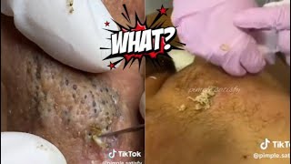 Ultimate ASMR Pimple Popping Extravaganza  Relaxing Blackhead Removal amp Skin Care [upl. by Ahsieker475]