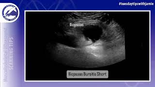 Iliopsoas Bursa Visualization on MSK Ultrasound [upl. by Nelaf214]