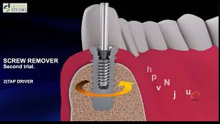 Dental Implant Prosthetic SCREW removal [upl. by Earazed]