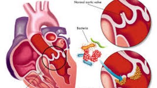 اقوى شرح Endocarditis بالتفصيل 💗🥰💫💯 [upl. by Whitson]