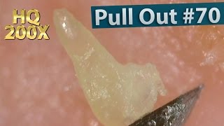 70 Pull Out Blackheads Close up 200X  Blackheads Removal [upl. by Eecram15]