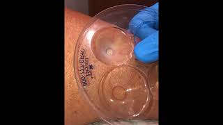 Liquid Nitrogen Cryosurgery Procedure at Facial Focus Cosmetic Surgery [upl. by Seitz611]