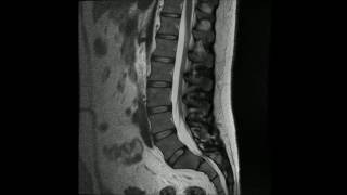 MR undersøkelse av normal korsrygg Normal lumbal columna [upl. by Dorcea]