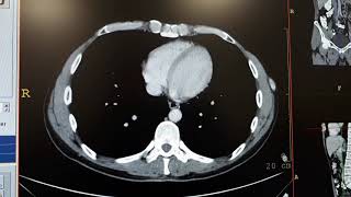 Hemangioma in liver ct [upl. by Oinotnaesoj]