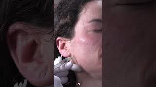 Facial Rejuvenation with Filler [upl. by Enaej514]