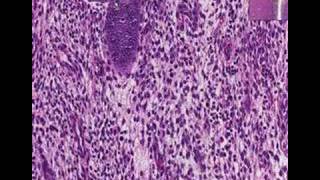 Histopathology Uterus endometriumProliferative endometriu [upl. by Ddat468]