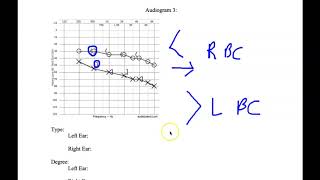 Audiogram interpretation 342 Fall2020 [upl. by Poulter389]