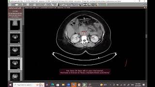 Mesenteric ischemia [upl. by Yelkreb]