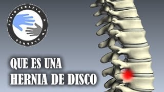 Hernia discal que es y como se produce [upl. by Wavell20]