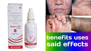 Powercort s lotion  clobetasol propionate and salicylic acid lotion benifit said effects dose [upl. by Keener]