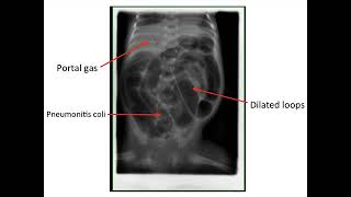 Paediatrics  complications of prematurity [upl. by Lecrad]