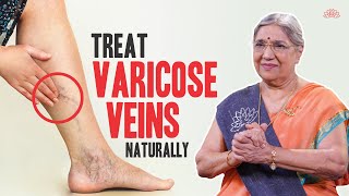 Natural Cure for Varicose Veins  Home Remedies to Treat Varicose Veins  Dr Hansaji Yogendra [upl. by Nakeber]