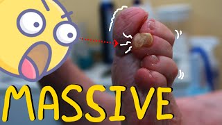 MASSIVE Toe Corn Removal Satisfying amp Painless [upl. by Yxor]