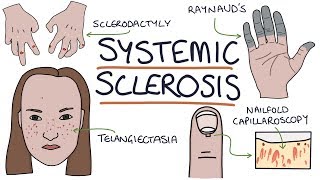 Systemic Sclerosis and Scleroderma Visual Explanation for Students [upl. by Ninnetta]