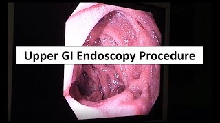 Upper GI Endoscopy Procedure in the ED [upl. by Kiley667]