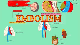 Pathology 18HDD 4  EMBOLISM  Pulmonary thromboembolism  Systemic thromboembolism AfSoomaali [upl. by Nonah]