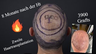 Haartransplantation auf der Tonsur 8 Monate späer [upl. by Llered]