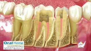 Endodoncia o tratamiento de conducto [upl. by Hashum]