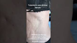 fibrosis fibrosispostlipo liposuction postoperatorio cirugíaestética tratamientos lipo [upl. by Berk340]