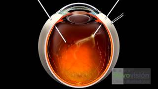 ¿EN QUÉ CONSISTE LA VITRECTOMÍA  CLÍNICAS NOVOVISIÓN [upl. by Tnattirb628]