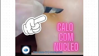 CALO MUITO DOLORIDO O TRATAMENTO COM PODOLOGA [upl. by Mulloy793]