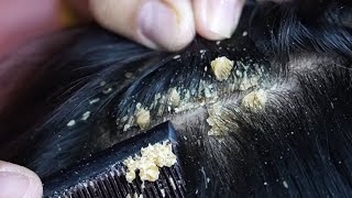 Dandruff scratching removal on head using black combing235 [upl. by Gschu712]