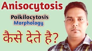 Anisocytosis in hindi  Poikilocytosis in hindi  Anisopoikilocytosis in hindi  RBC morphology [upl. by Akerdnuhs]