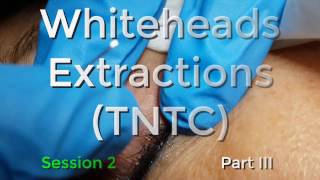 Whiteheads Extraction TNTC  Session 2 Part 3 of 3 [upl. by Igal]