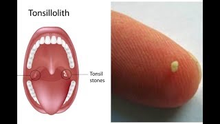 Tonsilloliths tonsil stones a patient education video by Carlo Oller MD [upl. by Ydnab972]