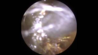 Eardrum bubble visible after Endoscopic Ear Wax Removal  Mr Neel Raithatha THC [upl. by Odnanreh93]