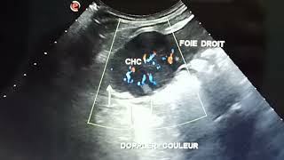 Échographie abdominale Carcinome hepatocellulaire CHC vampire [upl. by Sikleb64]