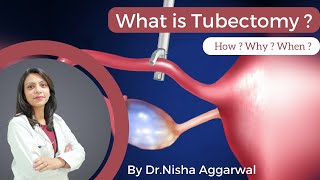 What Is Tubectomy  By DrNisha Aggarwal  How  Why  When   Female Sterilisation [upl. by Viv]