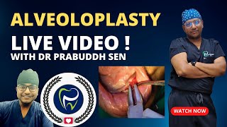 Dr Rudra Mohan  ALVEOLOPLASTY PROCEDURE LIVE  Preprosthetic Surgery  Smoothening Rough Jaw Bone [upl. by Seavir]