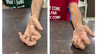 Forearm rotation before and after treatment of Amyotrophic Lateral Sclerosis ALS [upl. by Medeah]