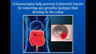 Learn what to expect when you have a Colonoscopy at BorlandGroover Clinic [upl. by Balcke]