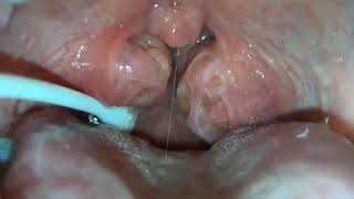 How to remove caseum from your tonsils [upl. by Aihsiym861]