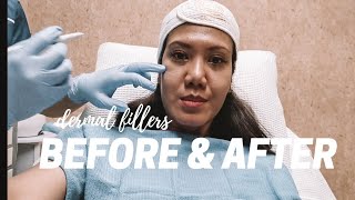 my first time dermal fillers under eyes and cheeks Restylane Philippines BEFORE amp AFTER [upl. by Aihsia]