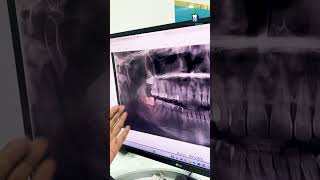 வலிக்காத ஞானப் பல்லையும் எடுத்து விடுங்கள்  Preventive Extraction of Wisdom Tooth  Denta Kings [upl. by Gnut457]