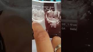 Gestational sac ultrasound report in urdu hindi [upl. by Gnahk]