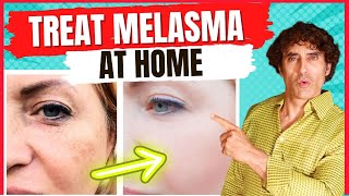 How to Treat MELASMA  Treat DARK SPOTS amp PATCHES on The SKIN [upl. by O'Driscoll]