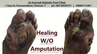 Diabetic Callus turned Gangrene salvage [upl. by Jac]