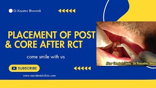 Placement of post amp core after rct [upl. by Egroeg741]